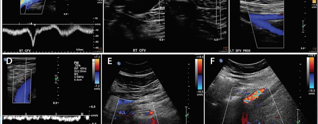 renkli-doppler-ultrasonografi-nedir