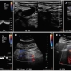 renkli-doppler-ultrasonografi-nedir