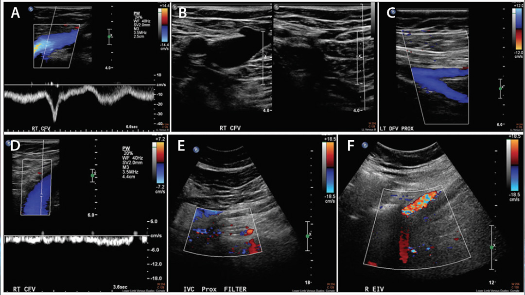 renkli-doppler-ultrasonografi-nedir